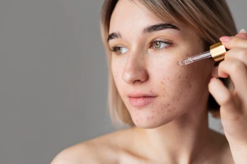 How Retinoids Help Clear Acne